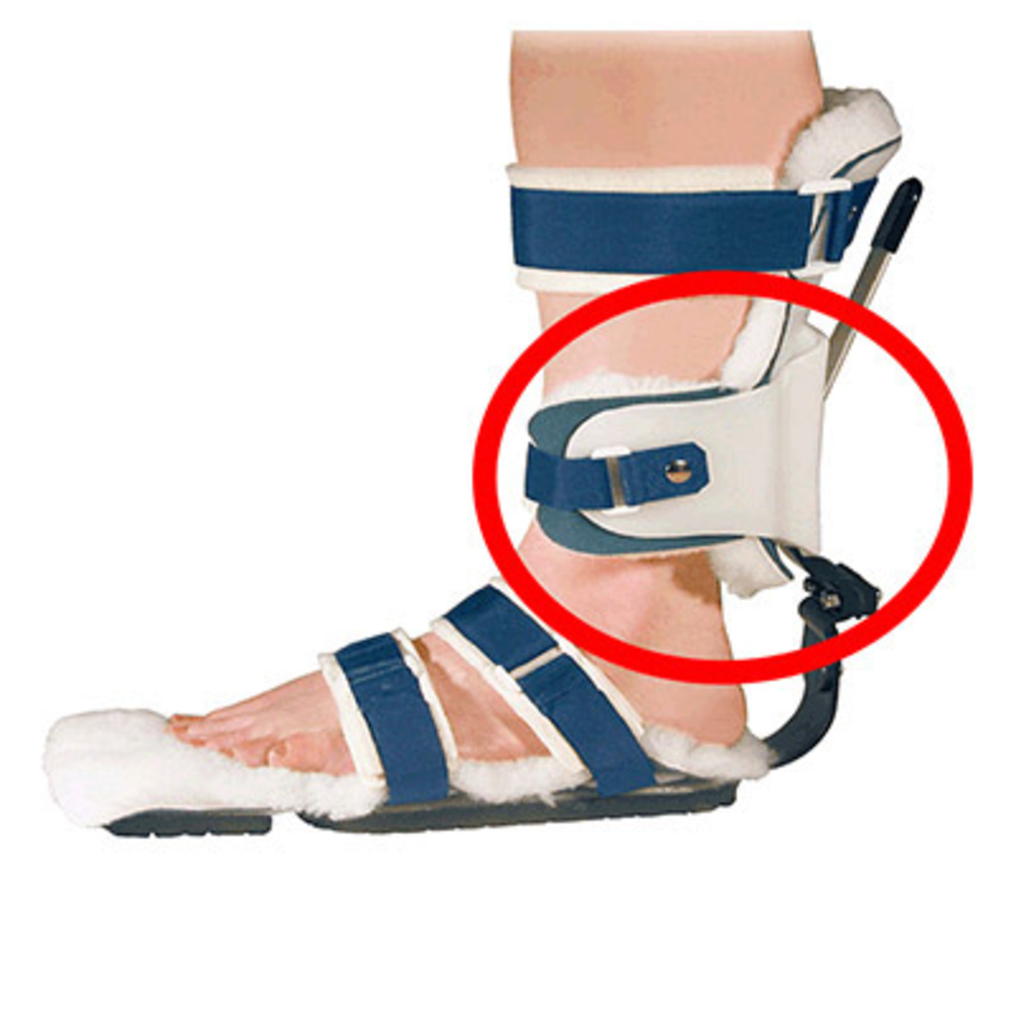 Varus Control Adaptation (VCA™)